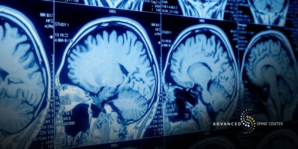 Occipital Neuralgia Diagnosis Plano