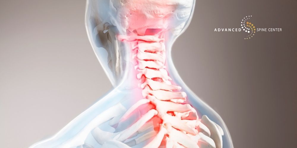 Occipital Neuralgia Symptoms