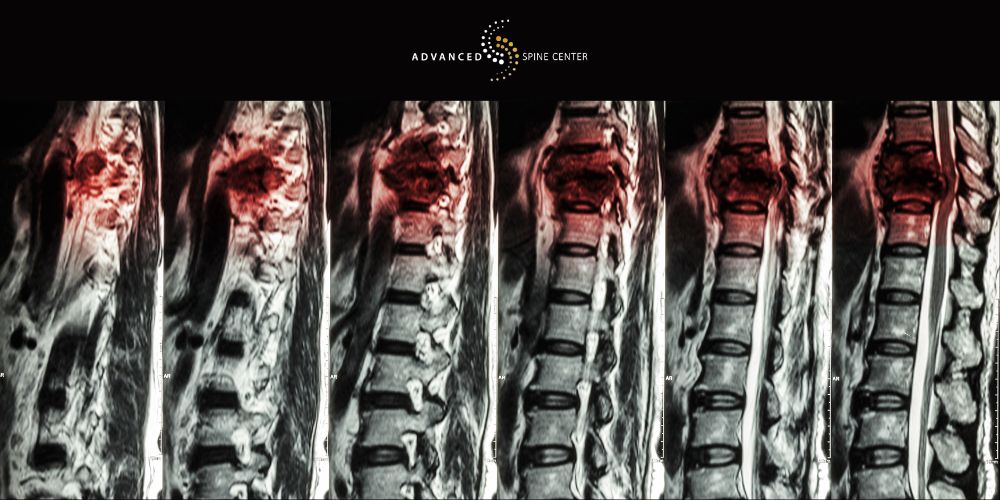 Spinal Compression Fracture Treatment in Plano, TX