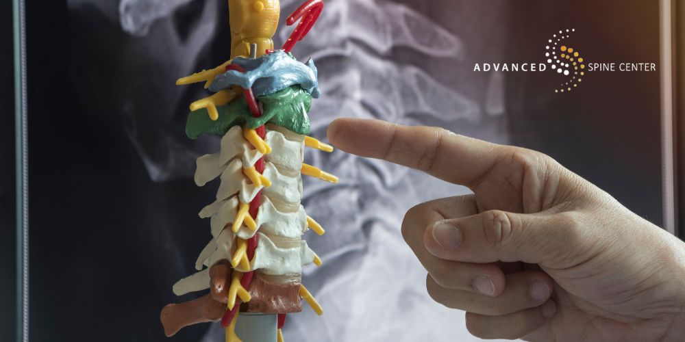 bilateral foraminal stenosis