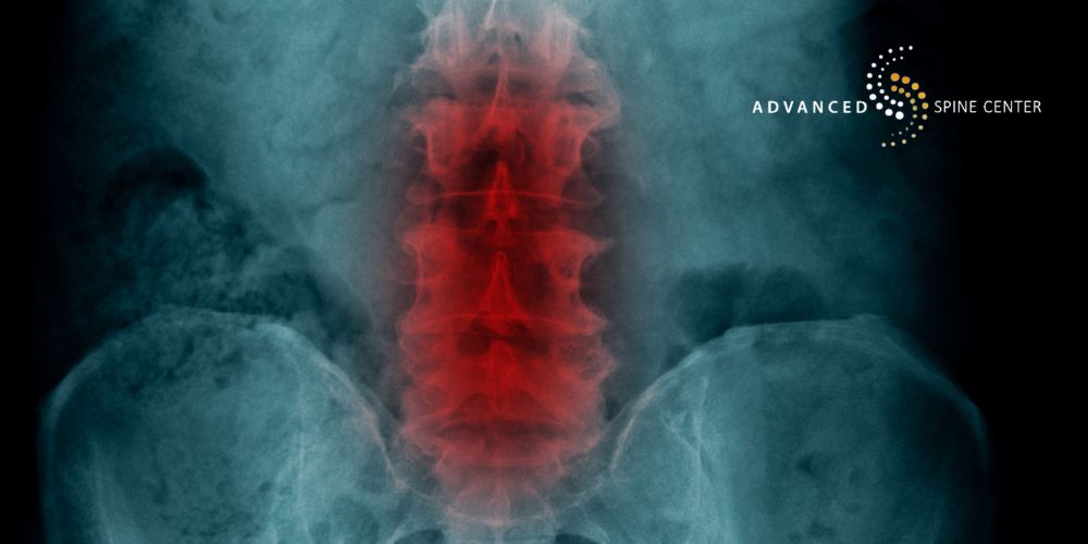 plano tx bilateral foraminal stenosis treatment