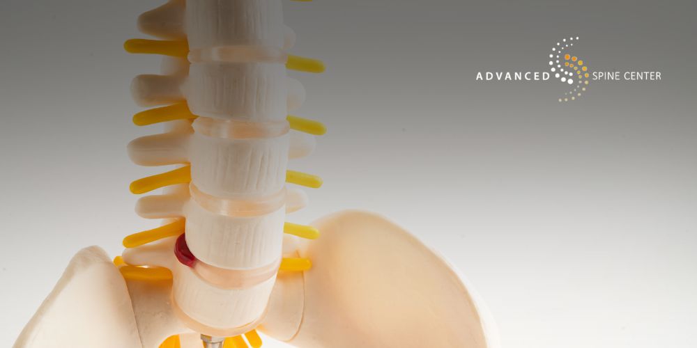 plano tx lumbar foraminal stenosis treatment surgeon