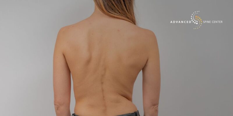 scoliosis in adults