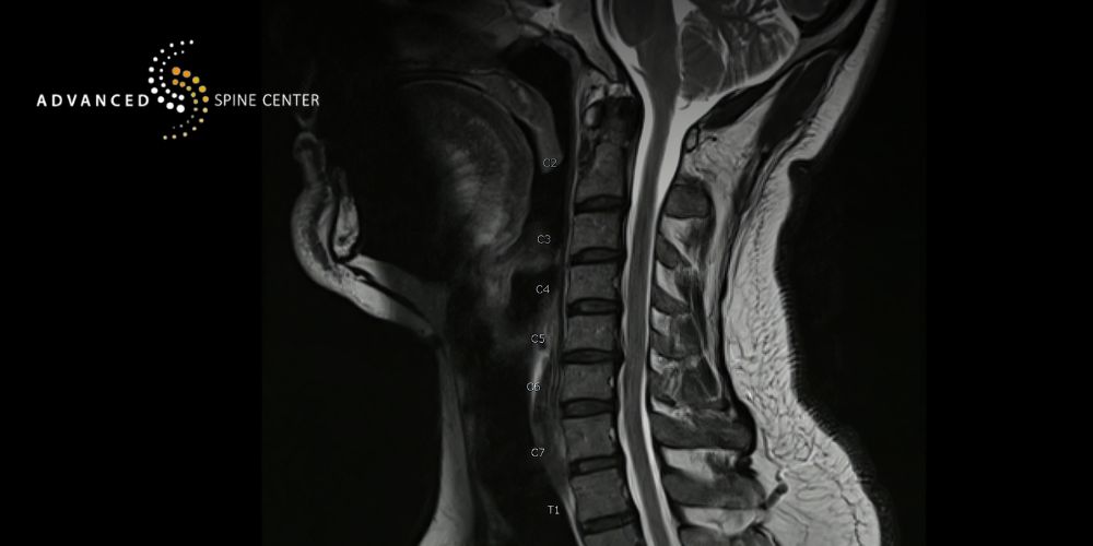 tx cervical foraminal stenosis treatment